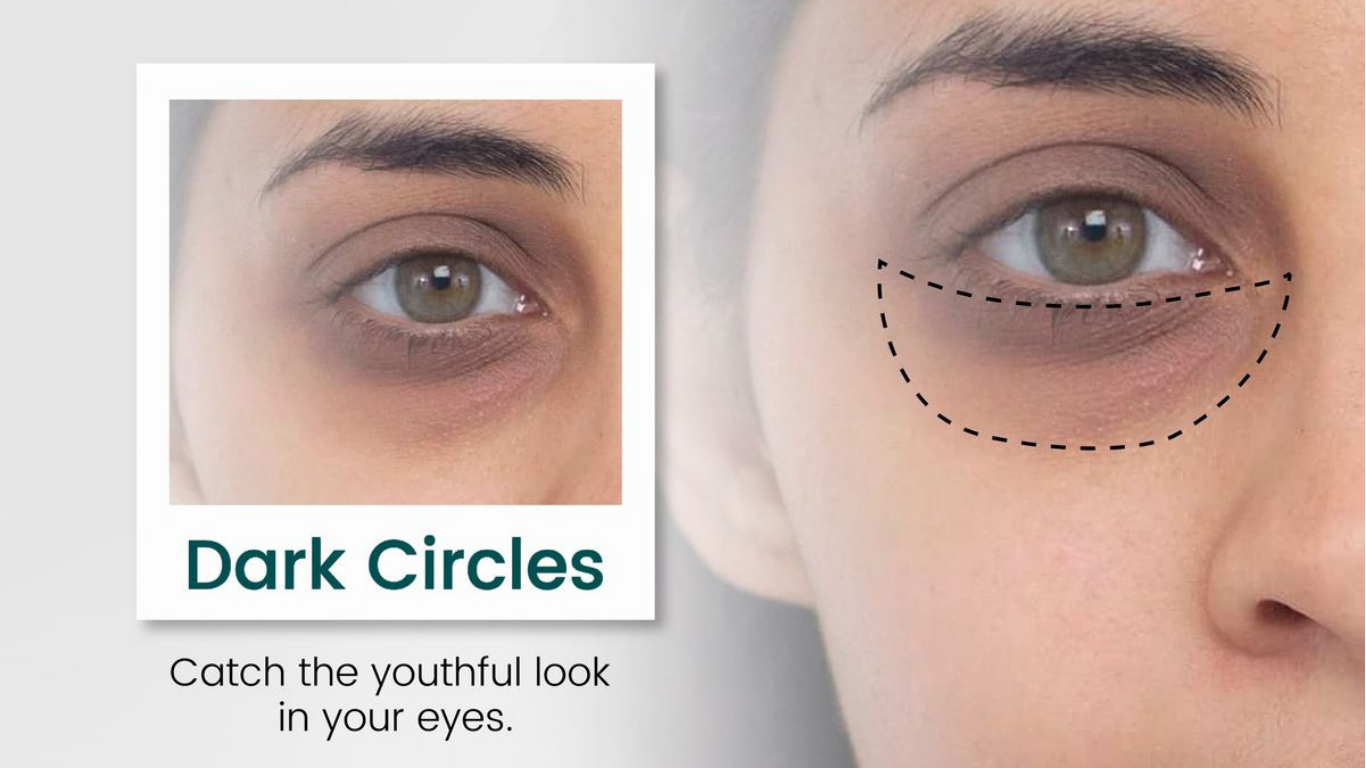 Dark Circles Naturally
